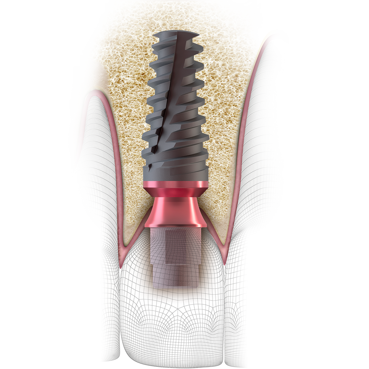 Genesis Active Conical Implant System – Keystone Dental Group